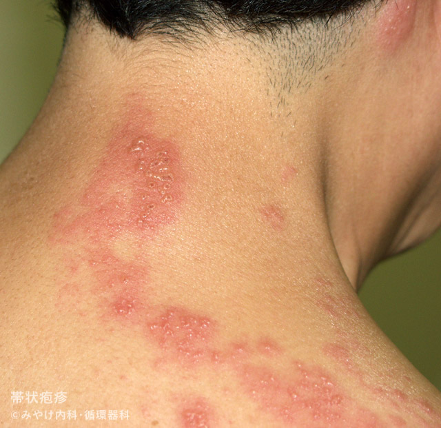 （写真3）帯状疱疹