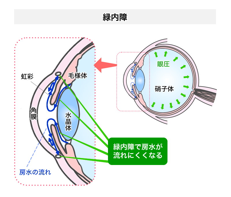 緑内障