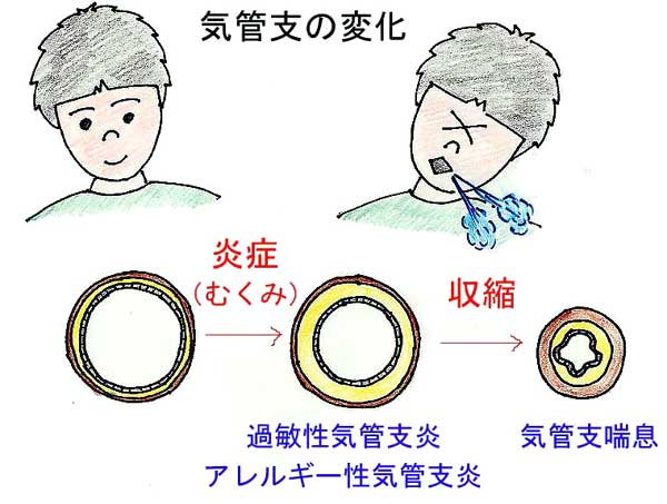 気管支の変化