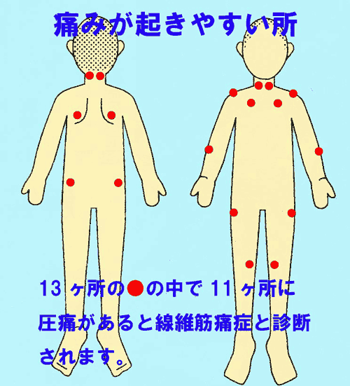 線維筋痛症の痛みが起きやすい所