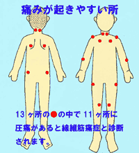 線維筋痛症