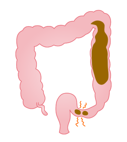 痙攣性便秘の病態イメージ