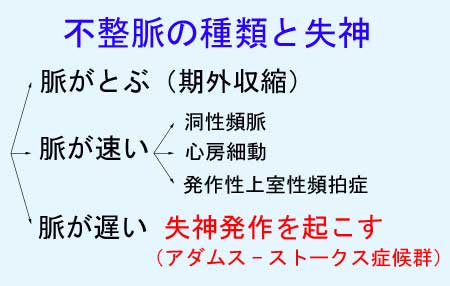 不整脈の種類と失神