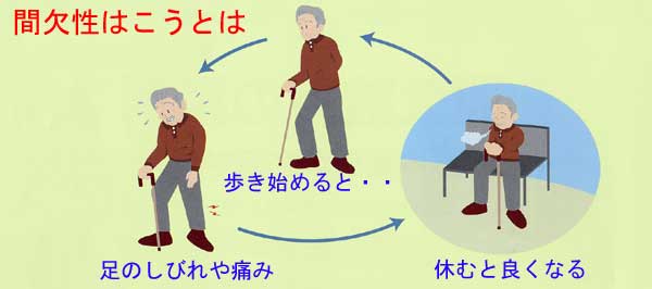 間欠性跛行とは