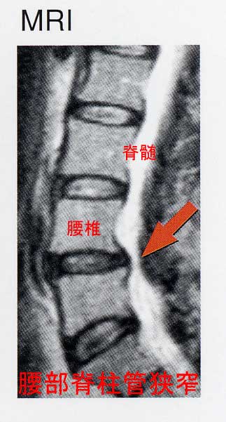 腰部脊柱管狭窄の狭窄部位