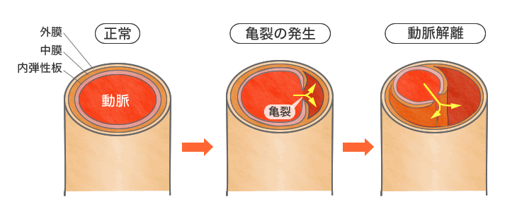 中年に多い椎骨動脈解離 診察室でよくみる大人の病気 みやけ内科 循環器科 院長ブログ