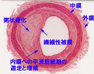 分かりやすい動脈硬化