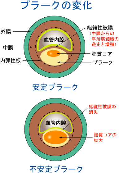 4 プラークの性状 分かりやすい動脈硬化 心臓 血管の話 みやけ内科 循環器科