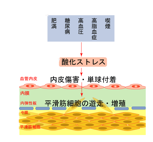 8 プラークの安定化 コレステロール低下療法 分かりやすい動脈硬化 心臓 血管の話 みやけ内科 循環器科