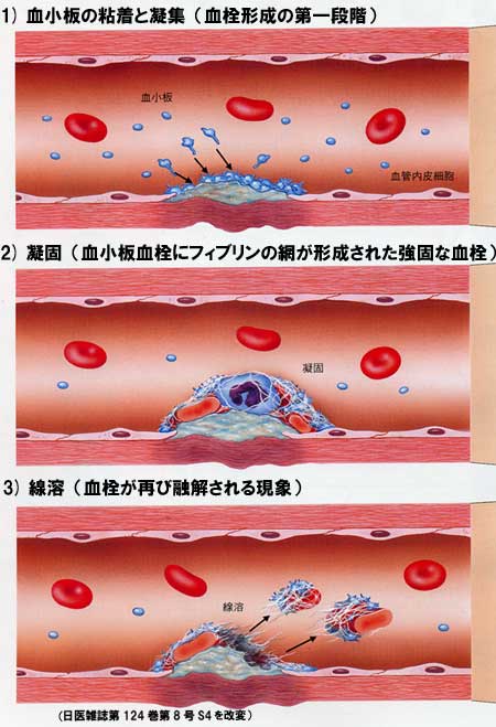 血小板と血栓の結成