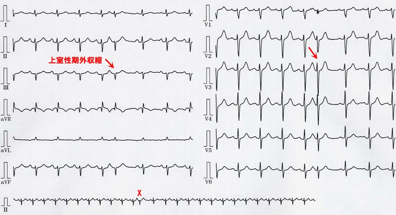 心電図：上室性期外収縮