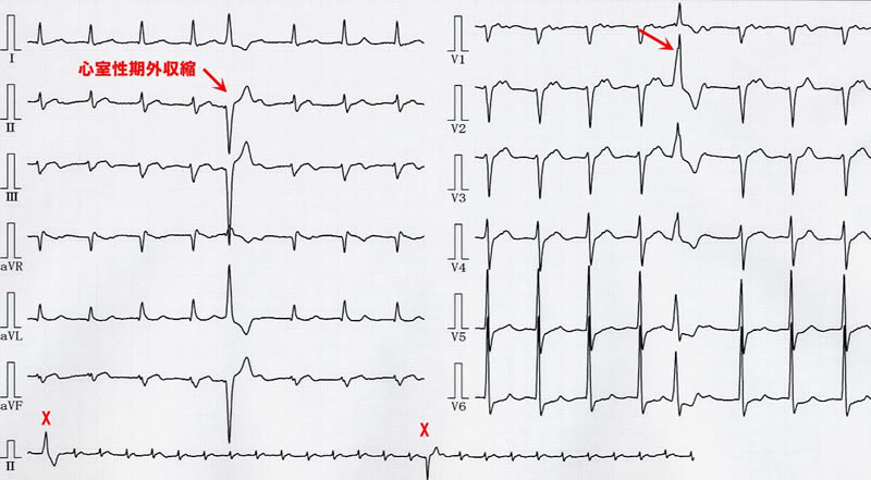 心電図：心室性期外収縮