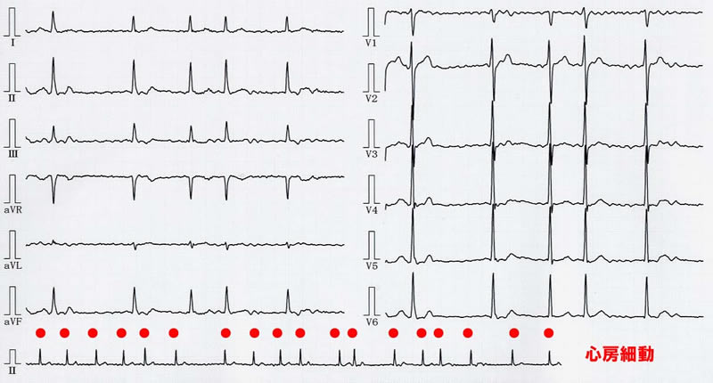 心電図：心房細動