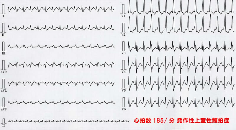 心電図：発作性上室性頻拍症