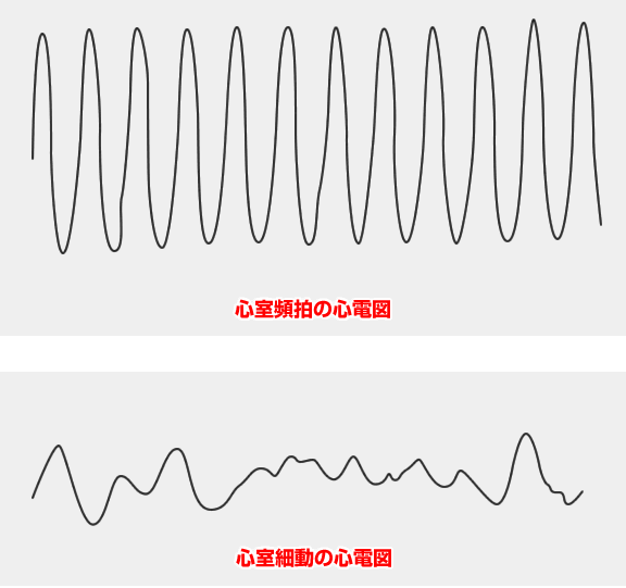 （心電図：心室頻拍と心室細動） 