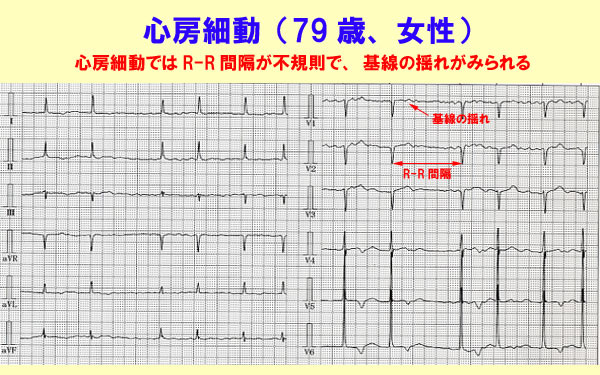 心房細動について