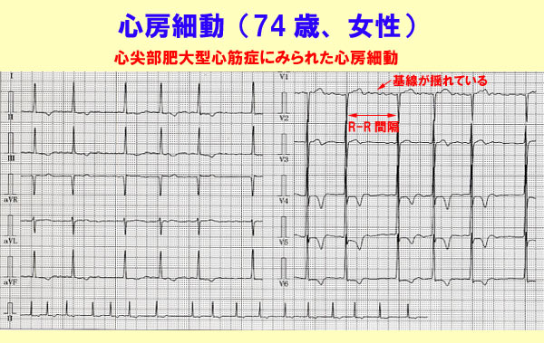 心房細動について