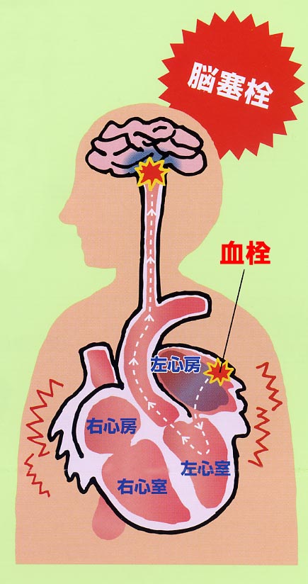 6.心房細動と血栓塞栓症