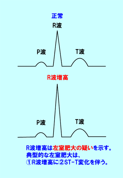 3.心電図の読み方－(5)｜誰でも分かる「心電図の簡単な読み方