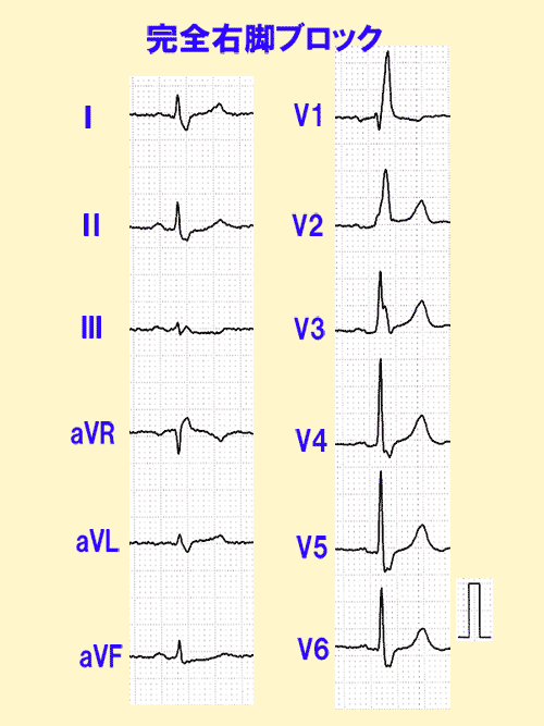 心電図の読み方(4)QRS波の幅から分かること