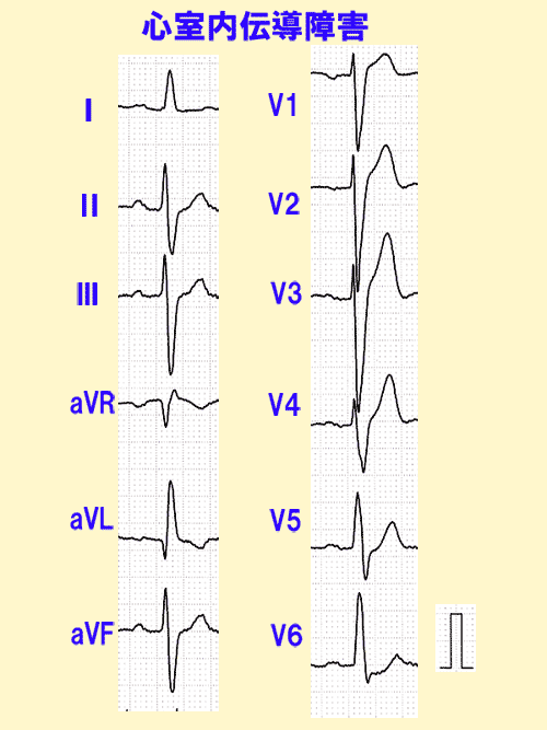 心室内伝導障害の心電図