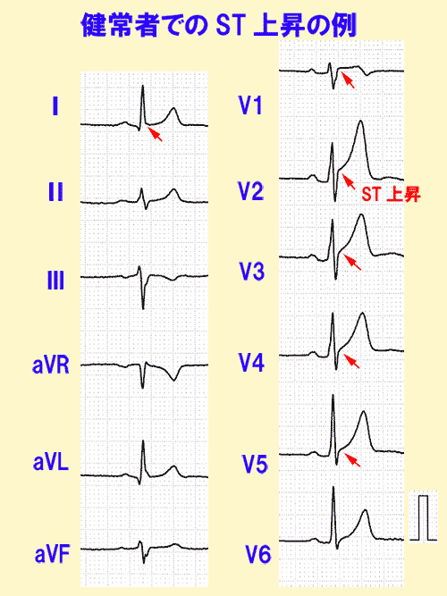 j 波 を 伴う st 上昇 と は