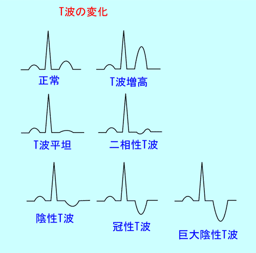 3.心電図の読み方－(5)｜誰でも分かる「心電図の簡単な読み方