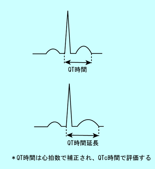 心電図の簡単な読み方：(7)QT時間の変化から分かること