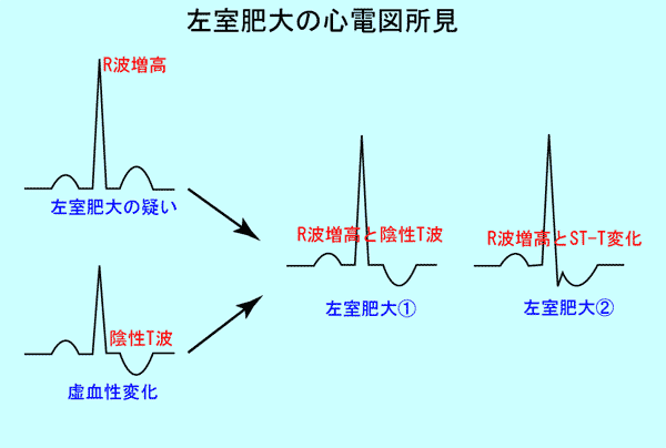 心肥大の心電図変化