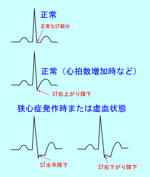 正常時と狭心症発作時または虚血状態の心電図