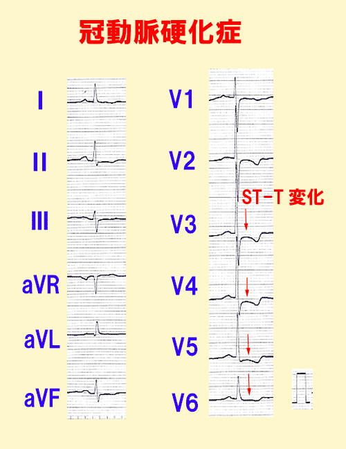 冠動脈硬化症の心電図