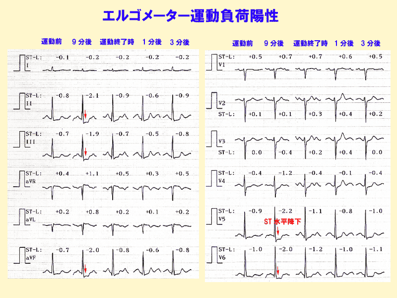 5 狭心症の心電図変化 誰でも分かる 心電図の簡単な読み方