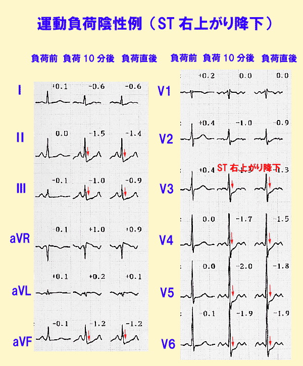 運動負荷陰性（ST右上がり降下）の心電図変化の例