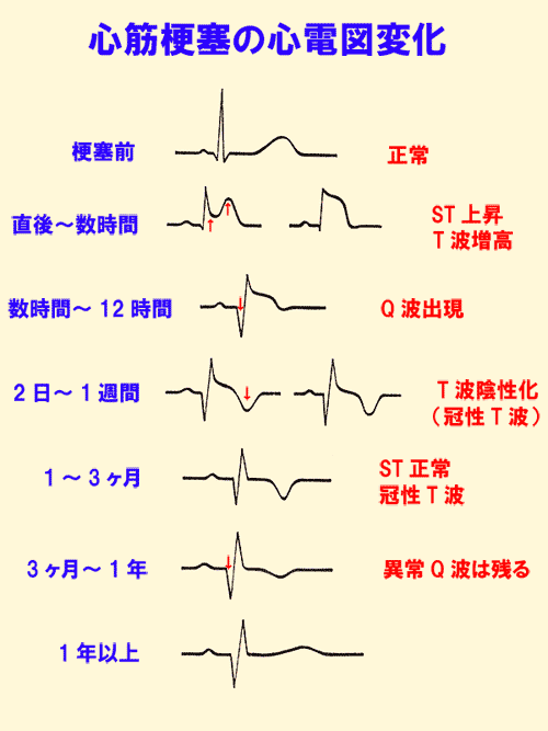 6 心筋梗塞の心電図変化 誰でも分かる 心電図の簡単な読み方 心臓