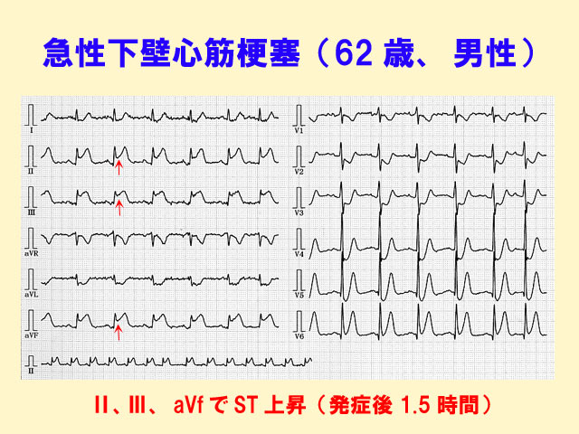 6 心筋梗塞の心電図変化 誰でも分かる 心電図の簡単な読み方 心臓