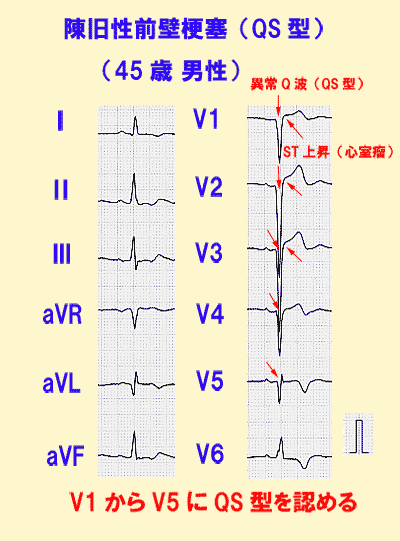 陳旧性前壁梗塞（QS型）の心電図