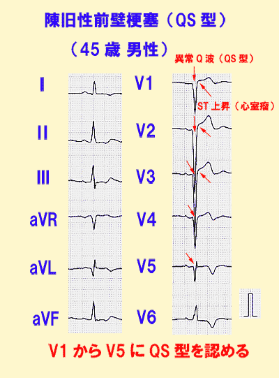 陳 旧 性 心筋 梗塞