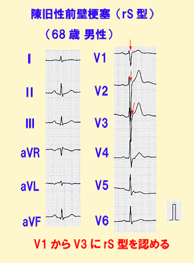 陳旧性前壁梗塞（rS型）の心電図