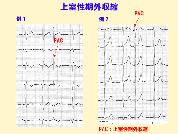 期 心室 外 収縮 性
