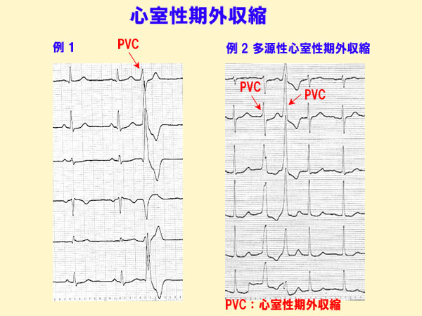 心室性期外収縮の心電図