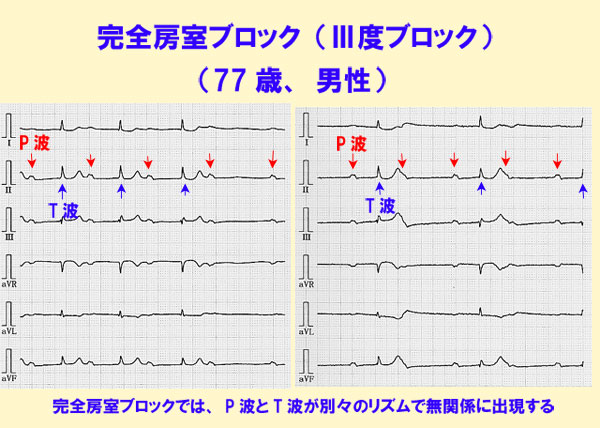 10 心電図 Q A 学校や職場の検診で心電図の異常といわれたら