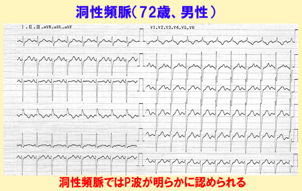 洞性頻脈の心電図