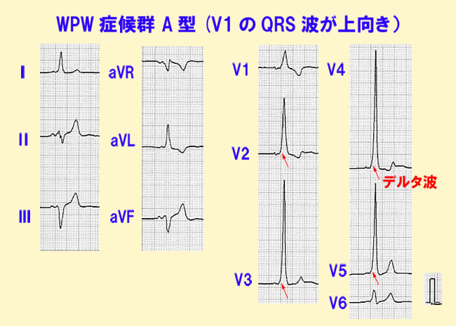 WPW症候群A型（V1のQRS波が上向き）の心電図