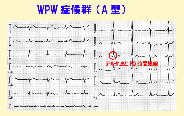 WPW症候群の心電図