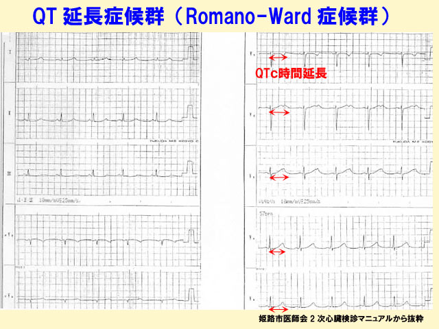 ロマノ-ワード症候群の心電図