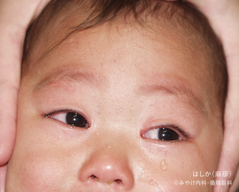 はしか 麻疹 写真で見る 子どもの病気 みやけ内科 循環器科