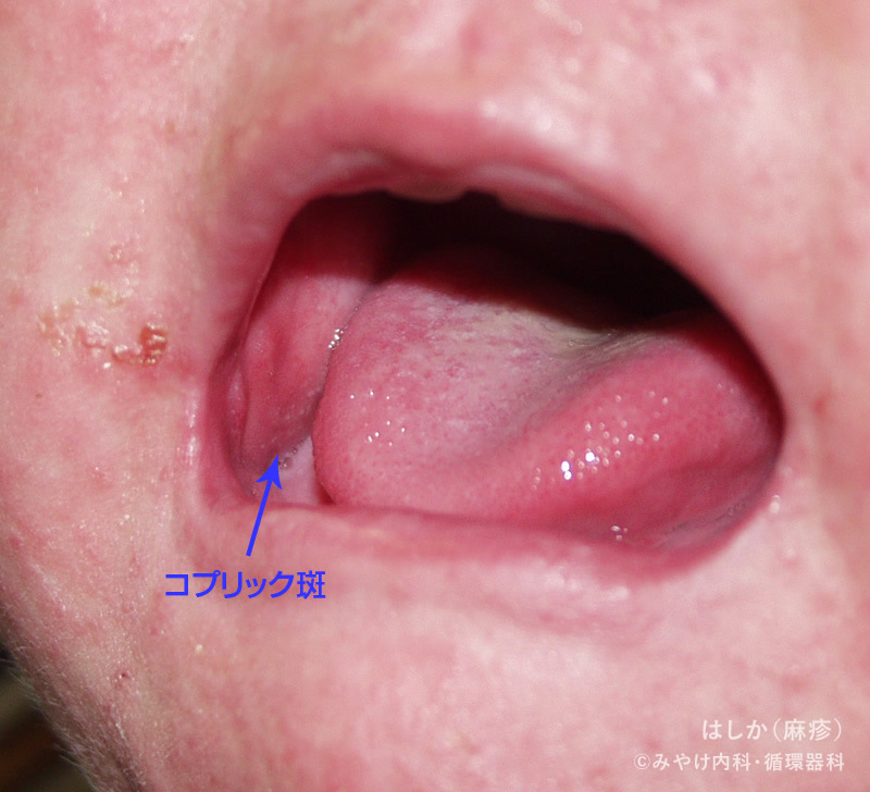 はしか（麻疹）-写真06　発病後5～7日（最盛期）コプリック斑