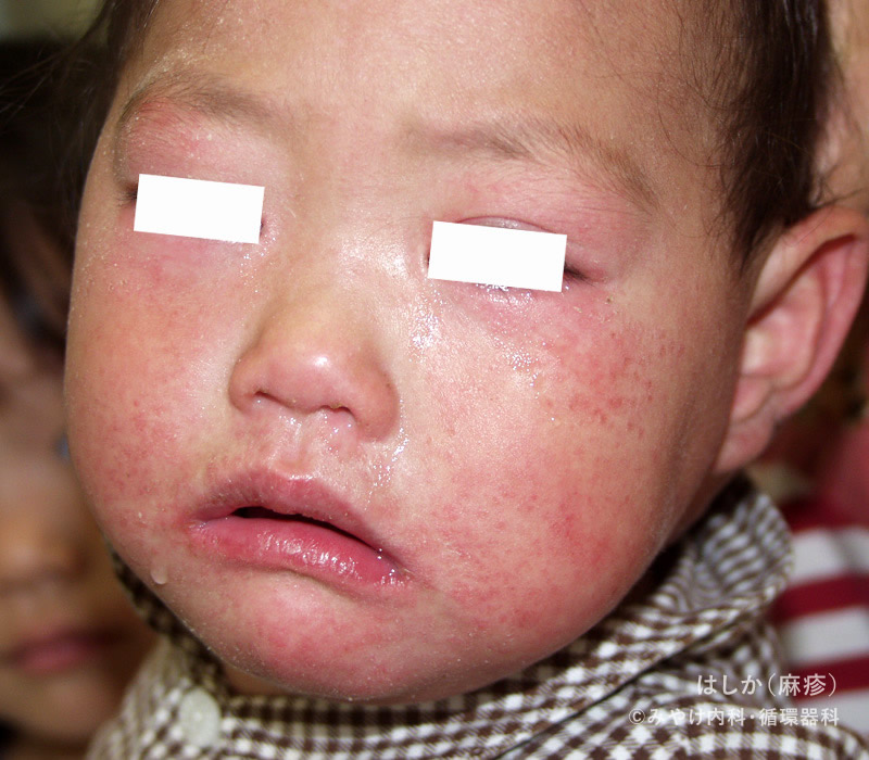 はしか（麻疹）-写真10　発病後8日～10日（回復期）