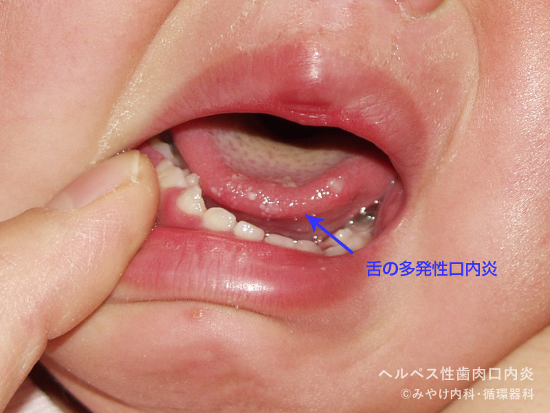 ヘルペス性（歯肉）口内炎-写真01　舌の口内炎
