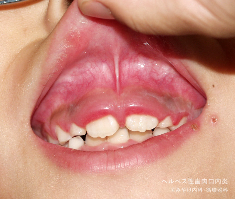 ヘルペス性（歯肉）口内炎-写真10　歯肉の発赤・腫脹